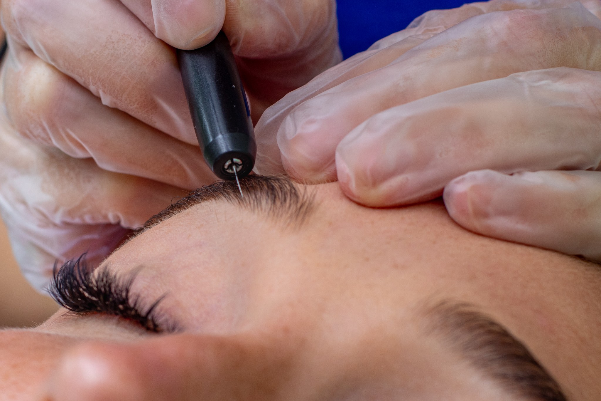 Stock image of woman receiving electrolysis hair removal on her eyebrow